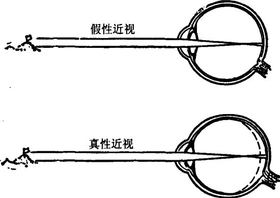 戴眼鏡會讓眼睛近視度數(shù)加深？