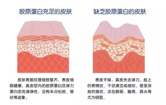 注射膠原蛋白真的能改善臉部皺紋？